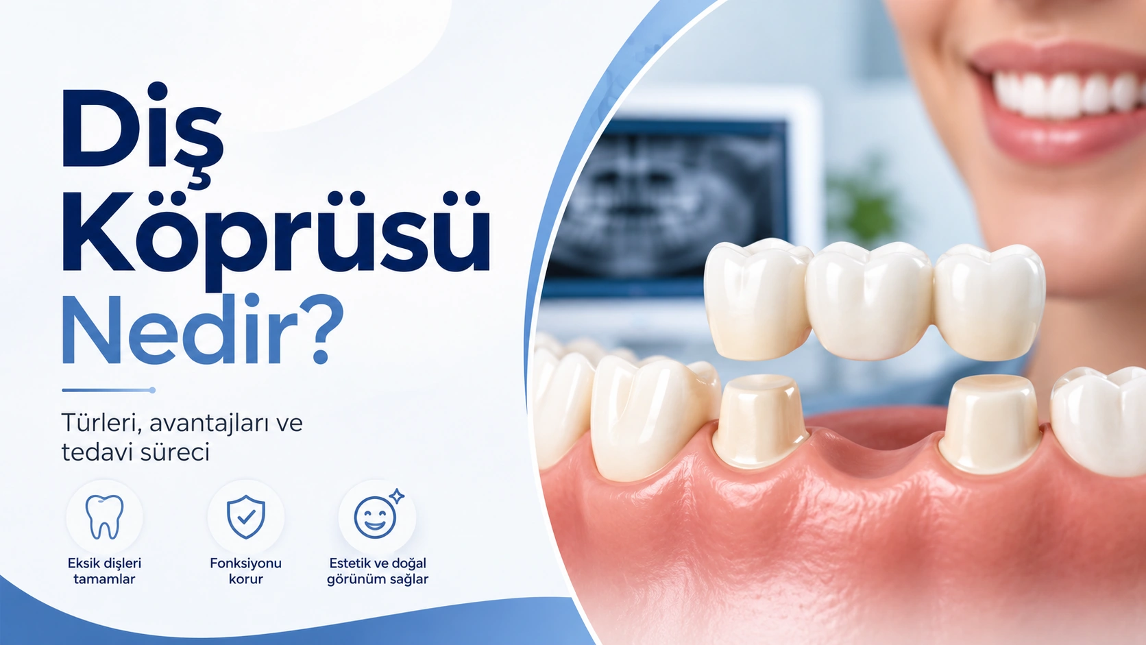 Diş Köprüsü Nedir? Çeşitleri, Süreci ve Ömrü